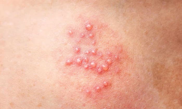 تبخال تناسلی