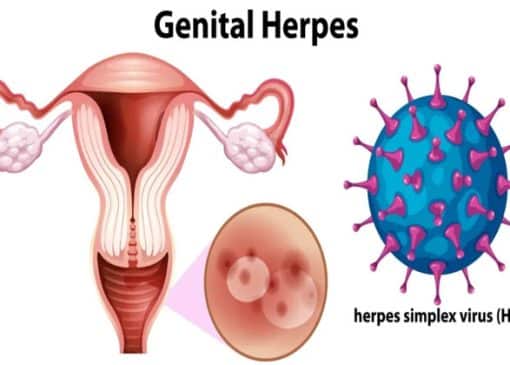 تبخال تناسلی