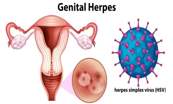 تبخال تناسلی