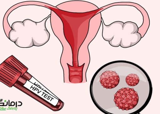 ویروس اچ پی وی چیست و راه درمان آن چگونه است
