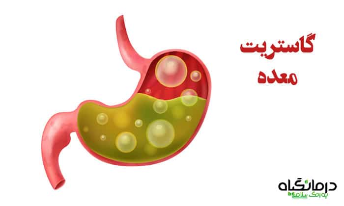 بهترین قرص برای گاستریت معده