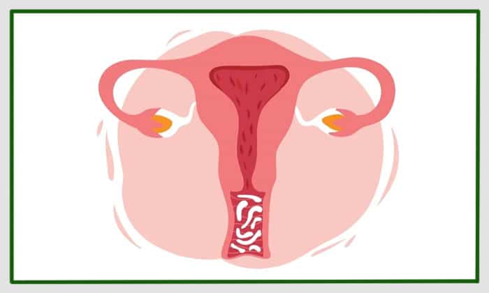 قوی ترین داروی ضد قارچ واژن