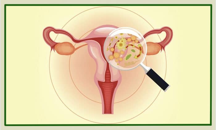 قویترین داروی ضد قارچ واژن