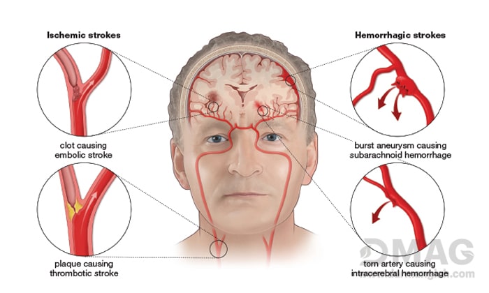 علائم سکته مغزی