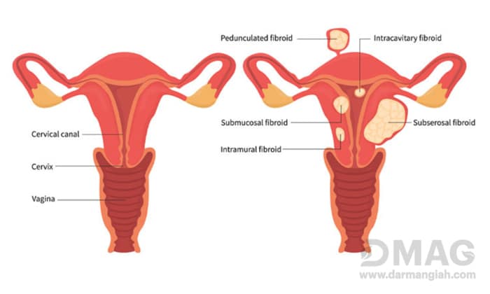 فیبروم رحم و 9 علامت آن