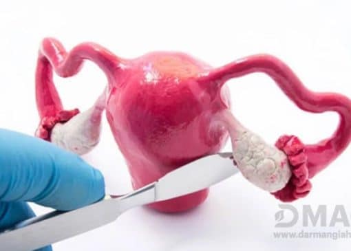 بهترین قرص برای تنبلی تخمدان