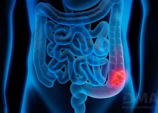 سرطان روده بزرگ چه علائمی دارد؟ درمان آن چیست؟
