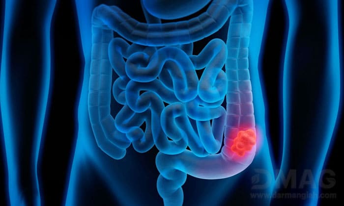 سرطان روده بزرگ چه علائمی دارد؟ درمان آن چیست؟