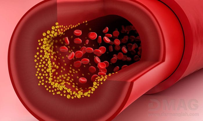 درمان تری گلیسیرید بالا در طب سنتی