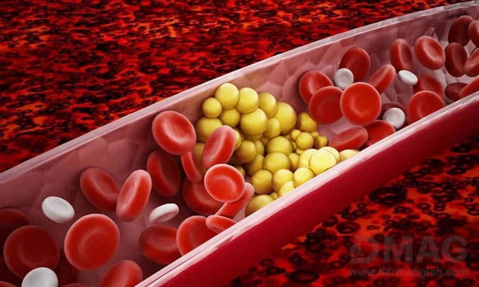 درمان تری گلیسیرید بالا در طب سنتی