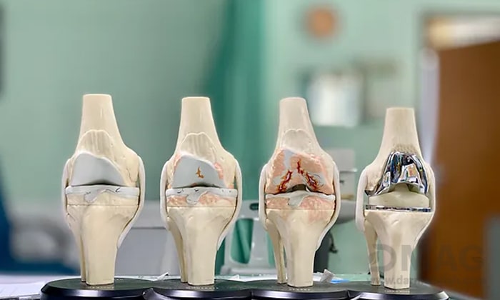 داروی آرتروز زانو