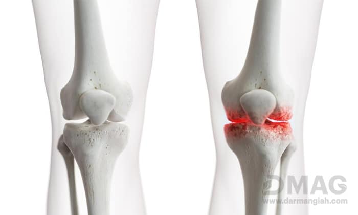 داروی آرتروز زانو