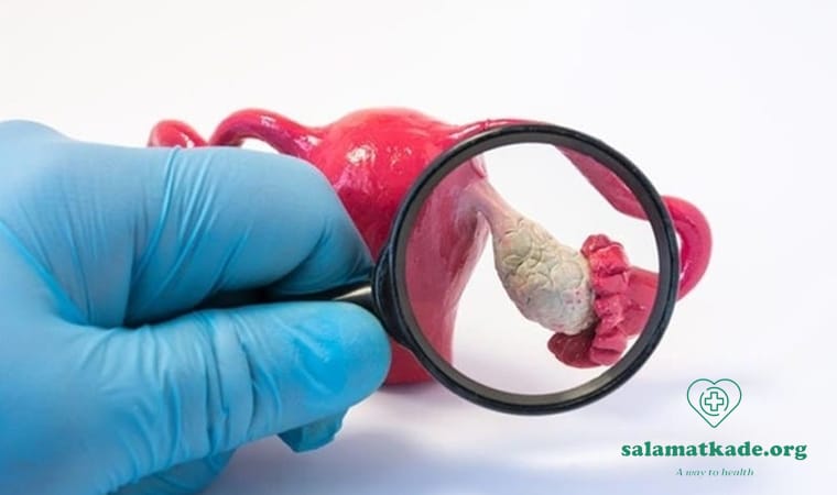 درمان تنبلی تخمدان در طب سنتی