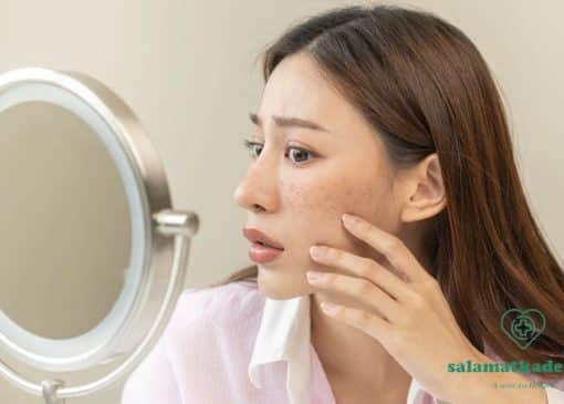 درمان لکه های پوستی ناشی از کبد چرب