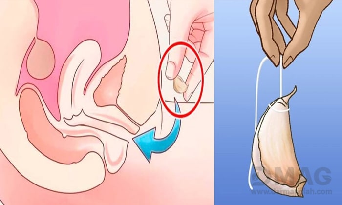 سیر برای عفونت واژن