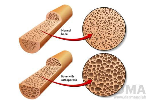 علائم پوکی استخوان و درمان گیاهی آن