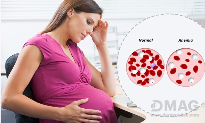 درمان کم خونی در بارداری