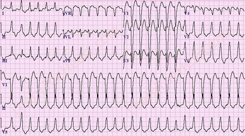 آریتمی EKG
