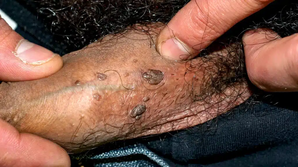 زگیل تناسلی در مردان