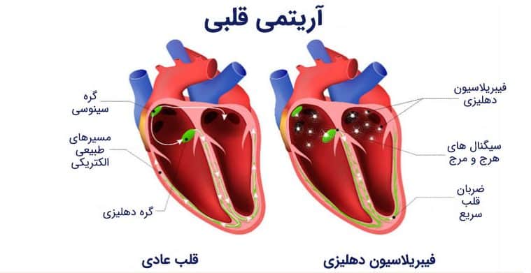 آریتمی قلب و داروهای گیاهی برای قلب و عروق