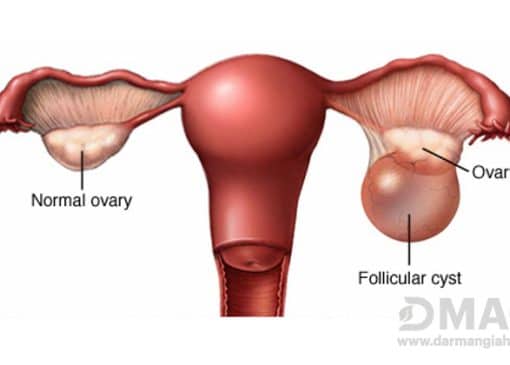 علائم و درمان کیست تخمدان