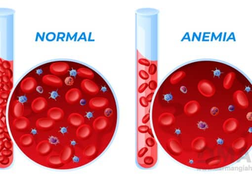 علت کم خونی شدید ناگهانی