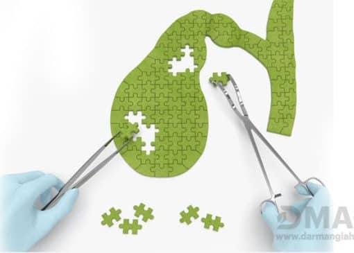 قرص پاکسازی کیسه صفرا