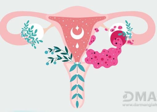 قاتل کیست تخمدان