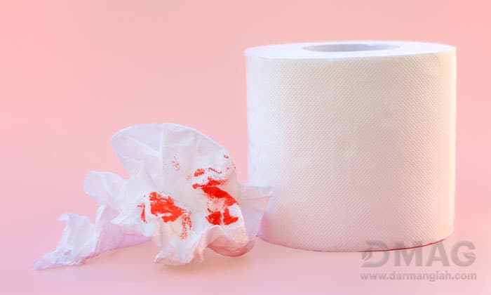 درمان سریع بواسیر درخانه