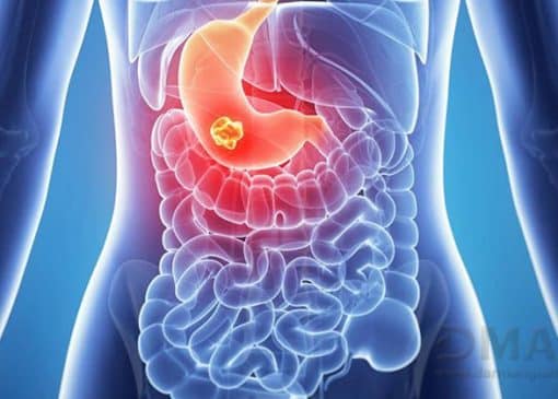 علائم زخم معده و درمان آن | معرفی 3 محصول موثر