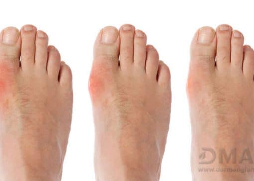 درمان نقرس در طب سنتی