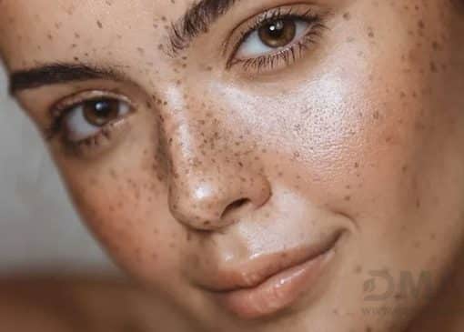 درمان لکه های پوستی ناشی از کبد چرب