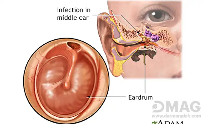 درمان سریع عفونت سوراخ گوش 2 درمان سریع عفونت سوراخ گوش