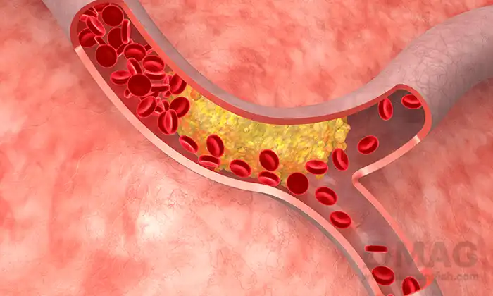 قاتل چربی خون بالا چیست