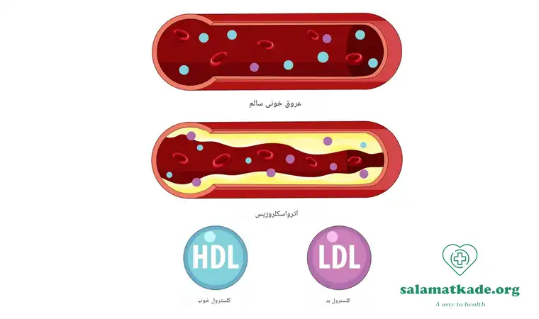 چربی خون بالا 