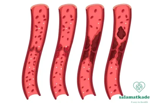 چربی خون بالا