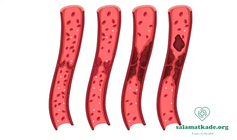 چربی خون بالا