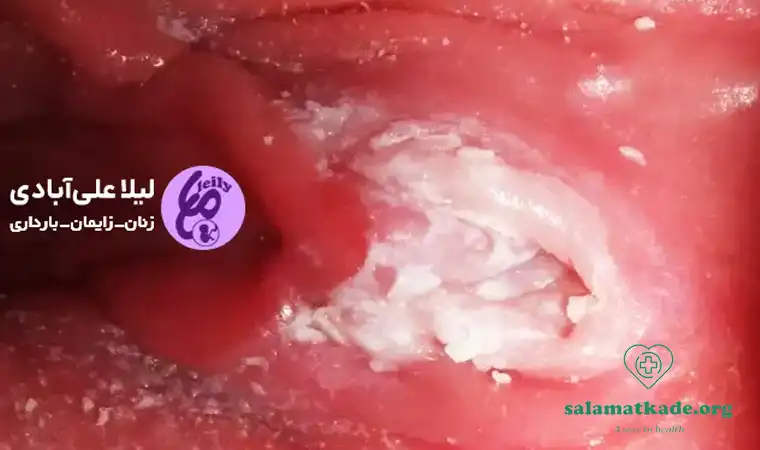 بهترین شیاف واژینال برای عفونت قارچی