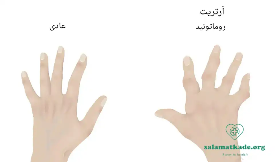 روماتیسم مفصلی میتواند با خشکی مفاصل همراه باشد