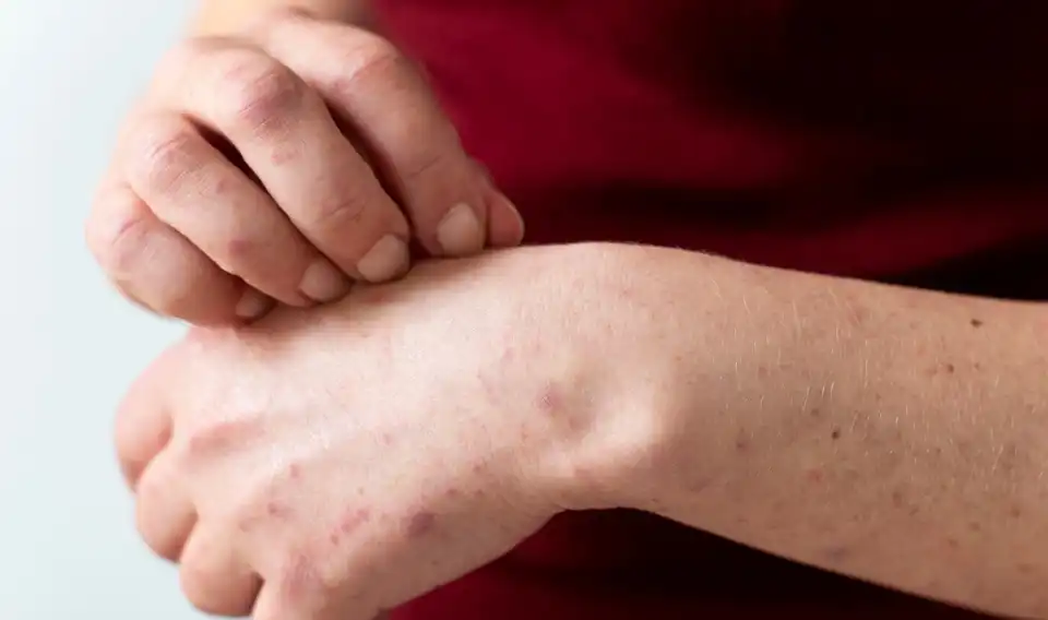 درمان قطعی اگزما