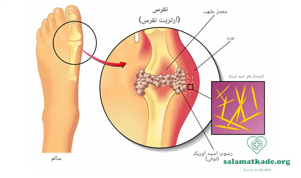 درمان خشکی مفاصل ناشی از نقرس با داروهای گیاهی