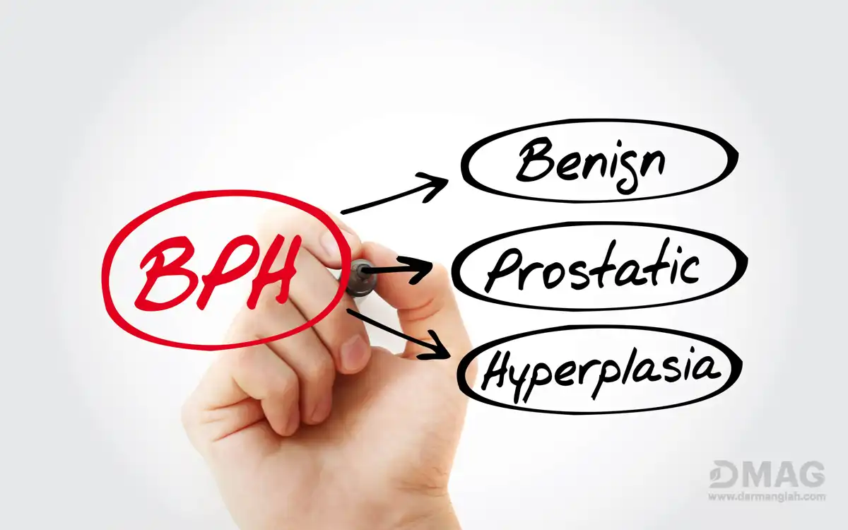 درمان بزرگی پروستات بدون جراحی