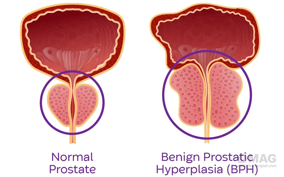درمان بزرگی پروستات بدون جراحی
