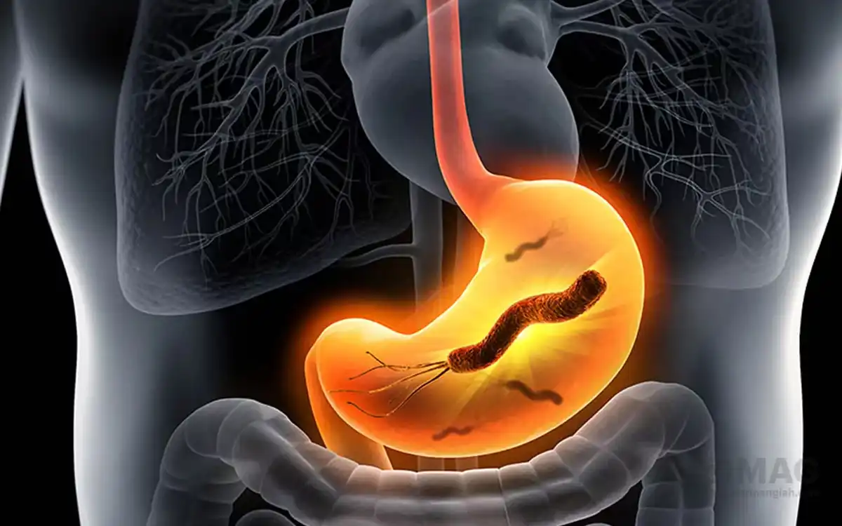 علائم میکروب معده و بهترین روش درمان آن
