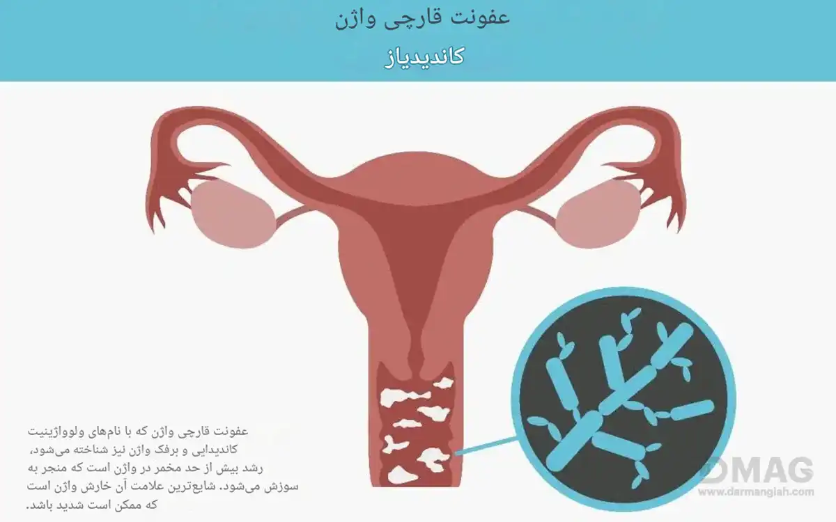 عفونت پنیری واژن