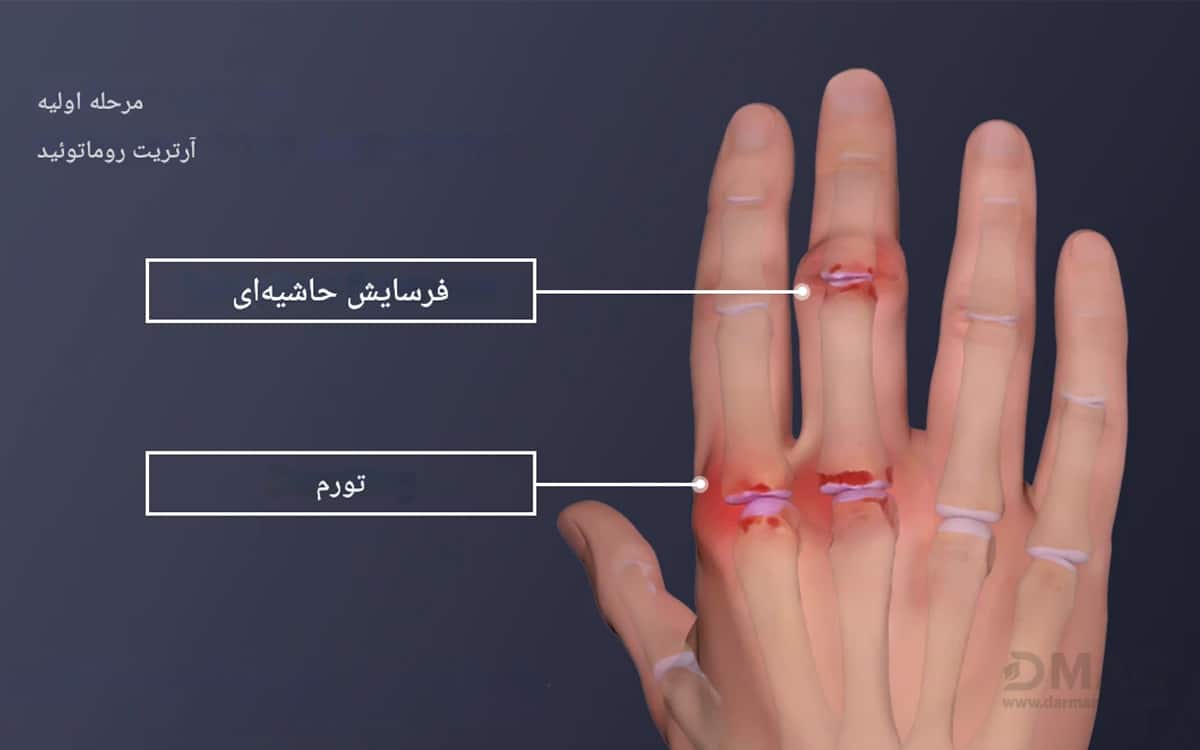 درمان روماتیسم مفصلی