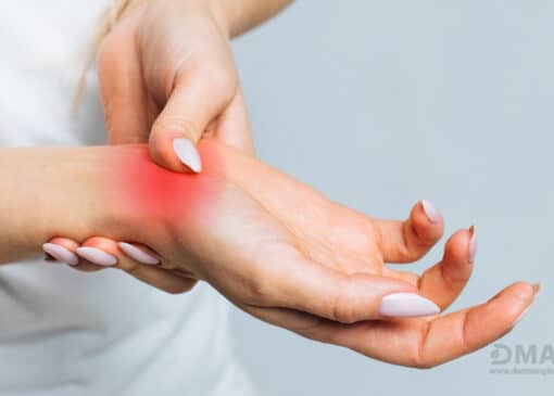 درمان روماتیسم مفصلی