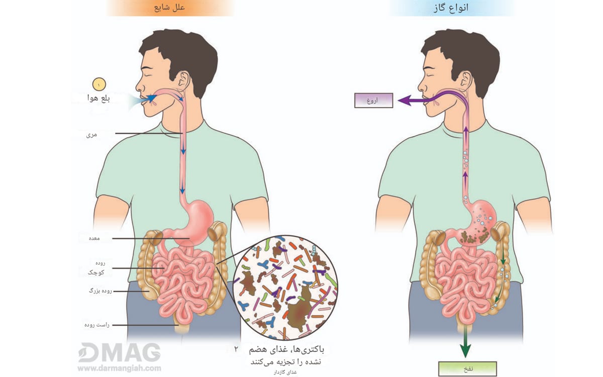 نفخ و آروغ در معده درد عصبی