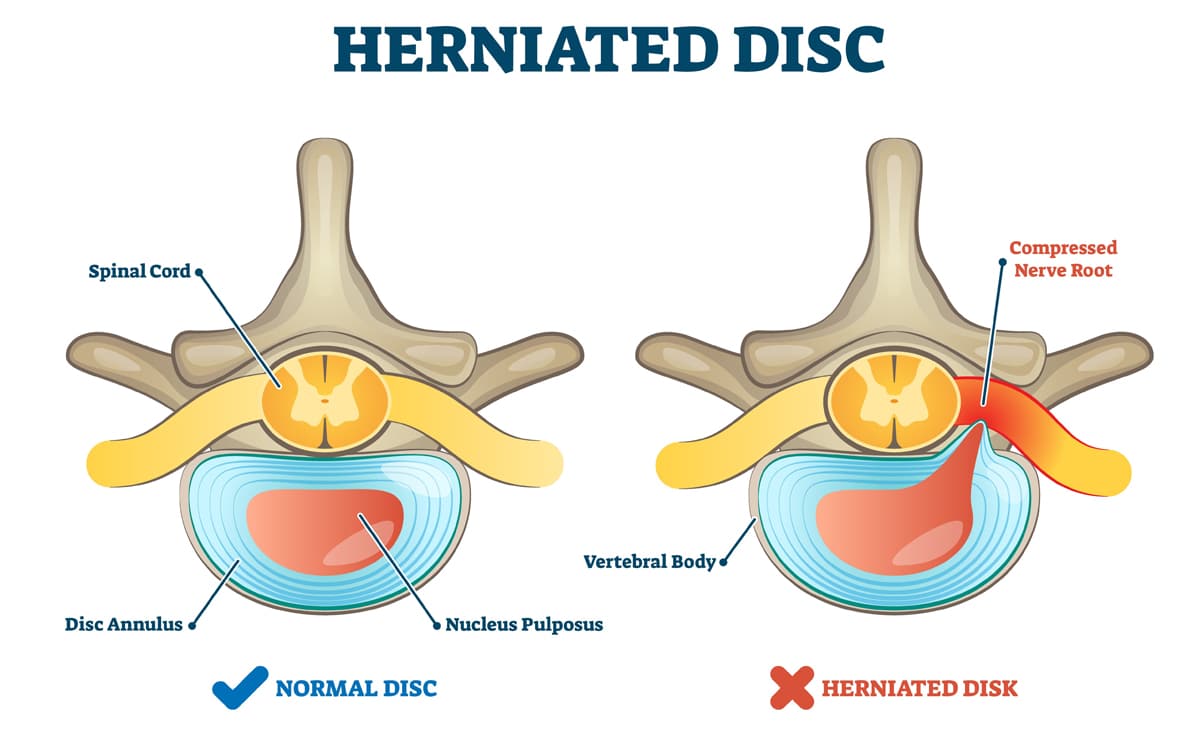 Herniated Disc