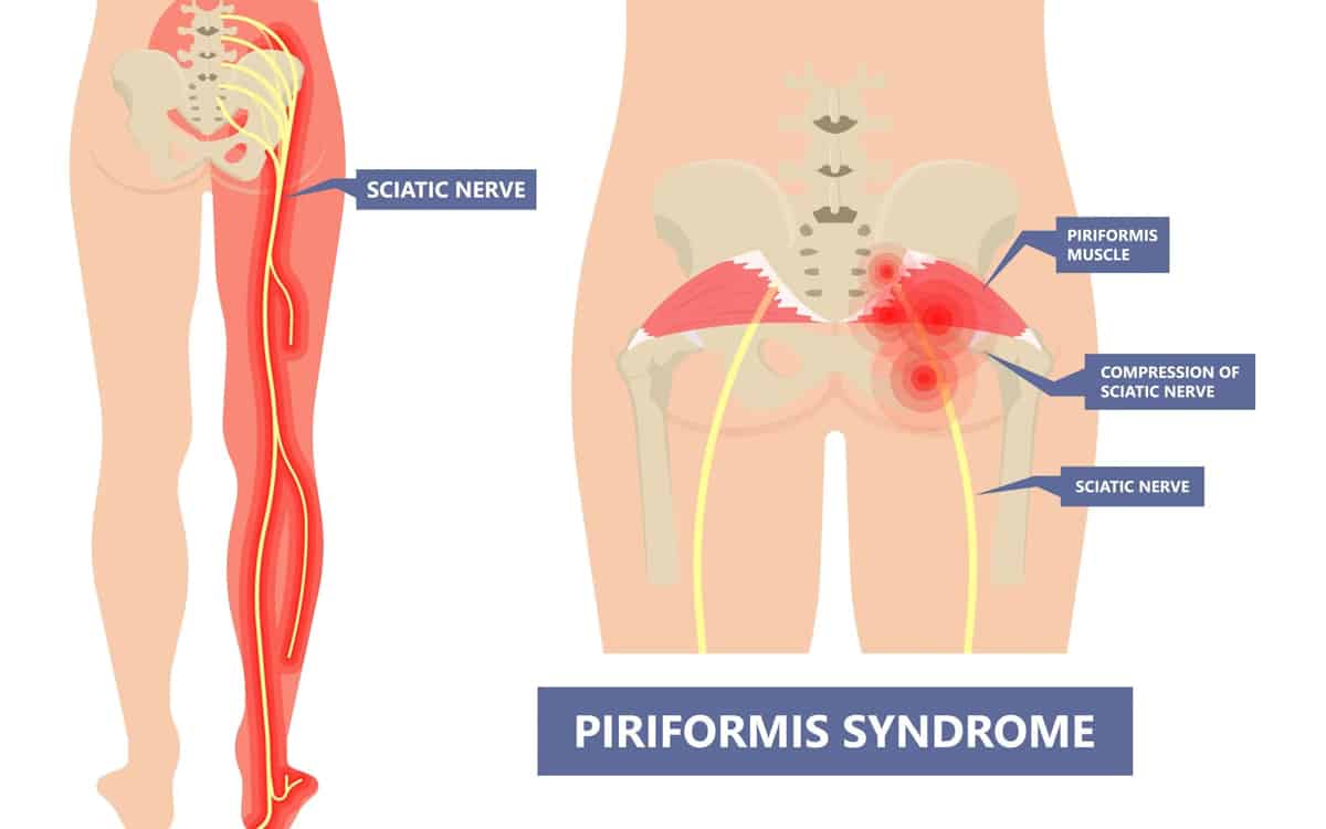 Piriformis-Syndrome